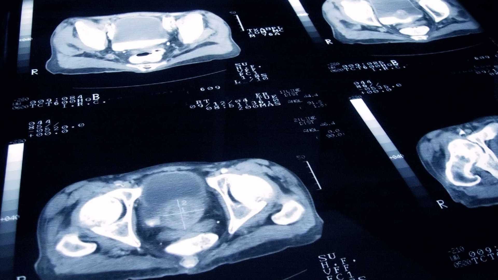 Há um teste que deteta o cancro da próstata, diz novo estudo