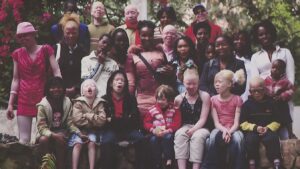 Pessoa albinas sofre discriminação e assassinatos