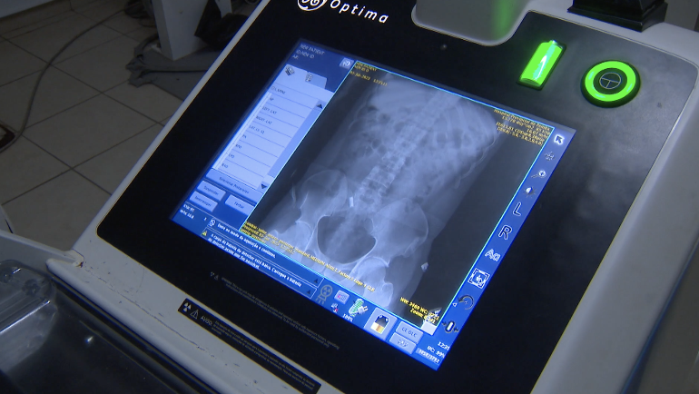 Hospital Provincial de Pemba: Máquina de radiologia está sem impressora